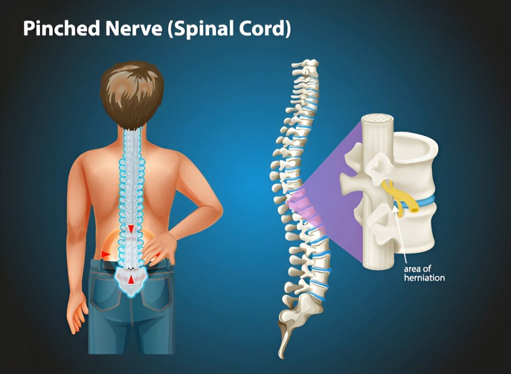 what does a pinched nerve in lower back feel like