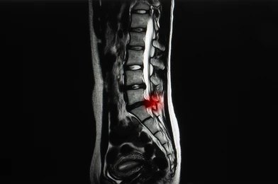 What is severe spinal stenosis?