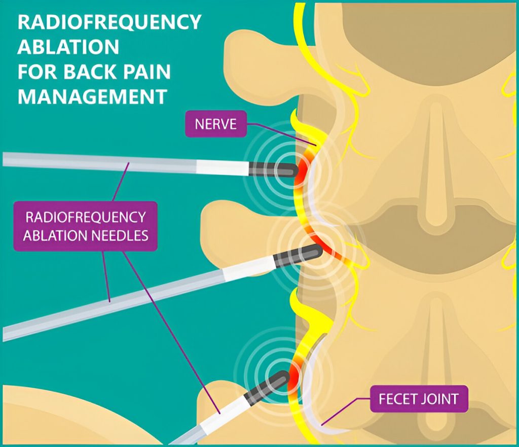 What is the Best Treatment for Sacroiliac Joint Pain?