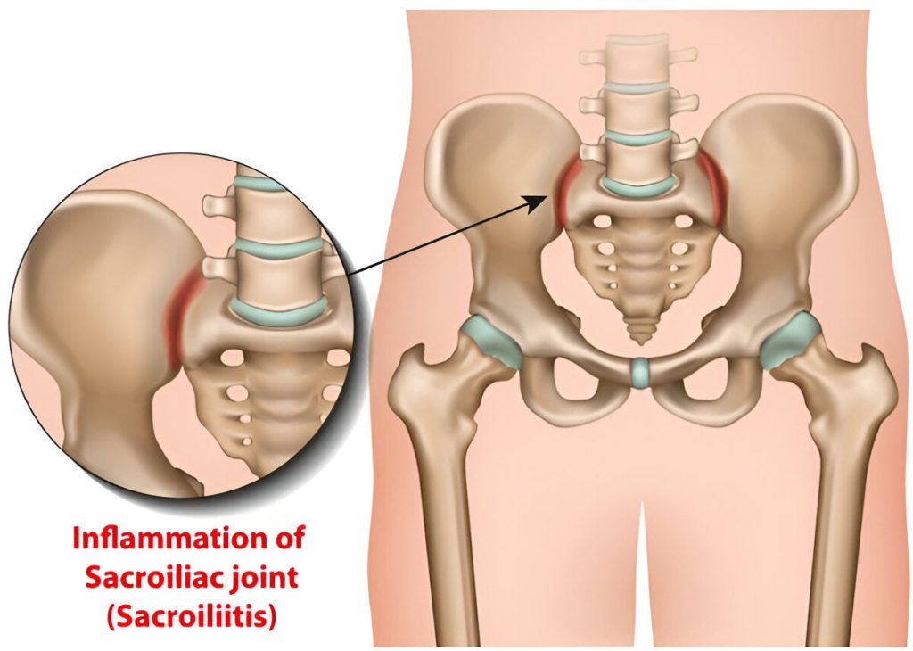 What is the treatment for sacroiliac joint pain?