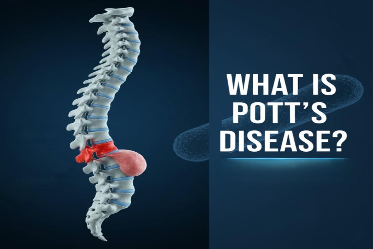 Pott's disease of the spine